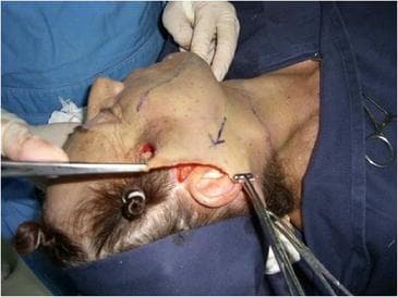 This intraoperative clinical photograph captures a key step in a rhytidectomy (facelift) surgical procedure. The image shows the facial and cervical region of a patient in a supine position, with the head oriented towards the left. A significant cutaneous flap has been undermined and is being retracted. Surgical instruments, including forceps and a retractor, are utilized by gloved hands to apply posterosuperior traction to the excess skin flap, following the tragus-Darwin’s tubercle line. Blue surgical markings, including an arrow indicating the primary force vector, are visible on the skin surface. The underlying subcutaneous tissue and SMAS (Superficial Muscular Aponeurotic System) layers are partially exposed near the preauricular area. This visual demonstrates the surgical management of skin laxity and the tension-free realignment of facial tissues during aesthetic or reconstructive surgery. The focus is on the biomechanical manipulation of the skin flap to achieve optimal redraping before excision of the redundant tissue.