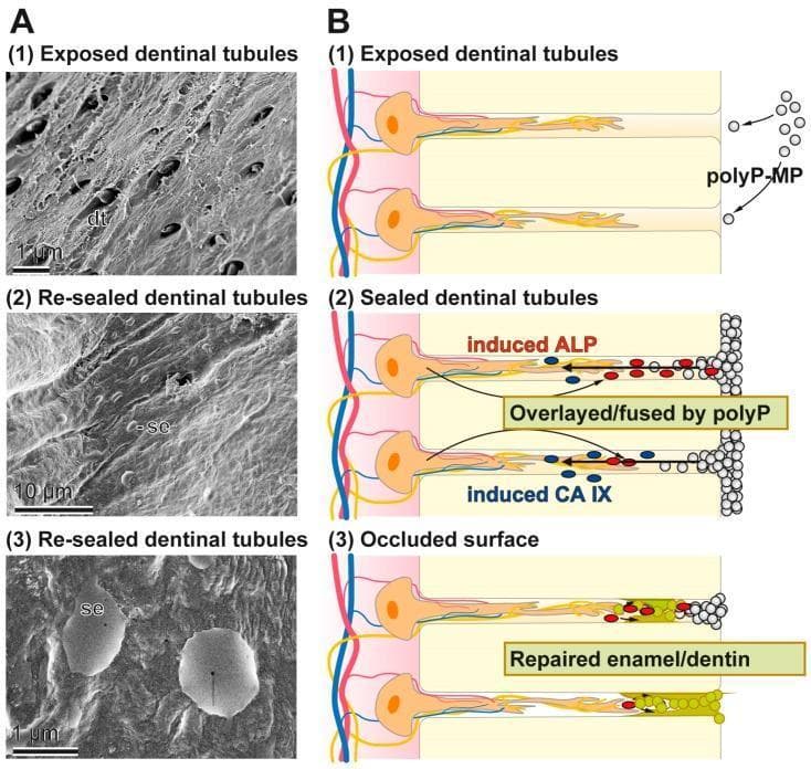This composite educational image illustrates the process of dentinal tubule occlusion using polyP-based microparticles, relevant to treating dental hypersensitivity and caries. Section A presents three scanning electron microscopy (SEM) images showing the progression from (1) 'Exposed dentinal tubules' with visible dark openings (dt), to (2) 'Re-sealed dentinal tubules' showing a smoothed surface (c-se), and (3) a high-magnification view of an 'Occluded surface' featuring globular mineral deposits (se). Section B contains a corresponding three-stage pathophysiology diagram. It depicts: (1) polyP-microparticles (polyP-MP) entering open tubules; (2) the biochemical interaction where polyP induces alkaline phosphatase (ALP) and carbonic anhydrase IX (CA IX), leading to fusion; and (3) the final state of 'Repaired enamel/dentin' where tubules are fully occluded. The diagram highlights the transition from exposed odontoblastic processes to a mineralized, sealed state. This material is designed for dental education focusing on biomaterial-driven tooth repair and mineralization mechanisms.