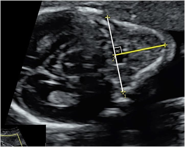 This diagnostic image is an axial fetal ultrasound used for prenatal craniofacial assessment. The scan demonstrates the fetal mandible and soft tissues of the lower face. Key anatomical landmarks and measurement points are highlighted to calculate the anteroposterior mandibular diameter (APD), an essential component of the jaw index. A white vertical line is drawn through the midline, extending from the tip of the mentum (Point 1) posteriorly to the base of the mandible. A second yellow horizontal line intersects the white line perpendicularly at Point 2 (at the level of the nasal bone synostosis), forming a 90-degree angle. This measurement protocol is clinically significant for evaluating fetal micrognathia or retrognathia. The jaw index is derived by dividing the APD by the biparietal diameter (BPD) and multiplying by 100. The image provides a standard reference for obstetricians and radiologists to assess mandibular growth and development during the second and third trimesters.