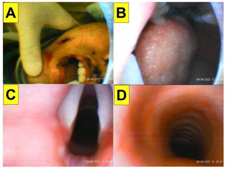 This sequence of clinical and intraoral images demonstrates the stages of endotracheal intubation using a video-assisted intubating stylet in a trauma patient. The images provide a first-person perspective of the airway progression. Panel A shows an external view of the mouth being manually opened, revealing teeth and minor perioral trauma. Panel B depicts the stylet's entry into the oral cavity, focusing on the posterior portion of the tongue. Panel C provides full glottic visualization, clearly showing the vocal cords, arytenoid cartilages, and the laryngeal inlet. Panel D shows successful tracheal entry, with the characteristic cartilaginous tracheal rings visible within the lumen. This series illustrates the clinical utility of optical stylets in navigating the airway and confirming tube placement in patients with restricted neck mobility, such as those in a cervical collar. The educational focus is on the sequential visualization of anatomical landmarks—from the oral space to the glottis and finally the trachea—to ensure safe airway management.