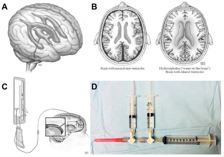 Educational medical composite illustrating hydrocephalus anatomy and external ventricular drain (EVD) management. (A) 3D anatomical diagram of the human brain showing the ventricular system, including lateral, third, and fourth ventricles. (B) Side-by-side axial illustrations comparing normal brain anatomy with hydrocephalus; the latter displays significant ventricular dilation and subsequent compression of surrounding brain parenchyma. (C) Medical illustration of an EVD Becker drainage system, showing the ventricular catheter's placement in the lateral ventricle and the external collection bag and pressure transducer setup. (D) Clinical photograph of a sterile isovolemic injection apparatus used for intraventricular drug administration (e.g., nicardipine). The setup includes a three-way stopcock connected to three syringes: a drug injection syringe, a sterile saline flush syringe, and a 10 mL cerebrospinal fluid (CSF) aspiration syringe. A red 18G needle is attached for port access. The composite demonstrates the clinical management of obstructive or communicating hydrocephalus, common in aneurysmal subarachnoid hemorrhage, emphasizing the 'volume out must equal volume in' isovolemic technique.