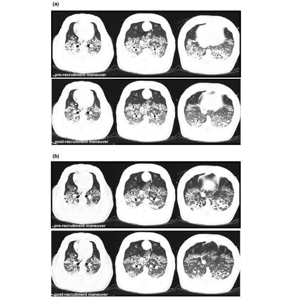 A series of axial thoracic CT scans illustrating lung recruitment in an animal model, likely used for studying Acute Respiratory Distress Syndrome (ARDS) or mechanical ventilation. The image is divided into two main panels: (a) Expiratory occlusion and (b) Inspiratory occlusion. Each panel contains a 2x3 grid comparing 'pre-recruitment maneuver' (top row) and 'post-recruitment maneuver' (bottom row) states at three anatomical levels: apical, middle, and basal. In the 'pre-recruitment' images, there are significant bilateral areas of high density (ground-glass opacities and consolidation) predominately in the dependent (posterior) lung regions, indicating atelectasis and non-aerated lung tissue. Post-recruitment, there is a visible reduction in these dense areas and a concomitant increase in radiolucency (darker regions), signifying improved alveolar aeration and lung volume (Vgas). The changes are most pronounced in the basal levels during both expiratory and inspiratory occlusions, demonstrating the effectiveness of the maneuver in opening collapsed alveoli and homogenizing lung parenchyma density.