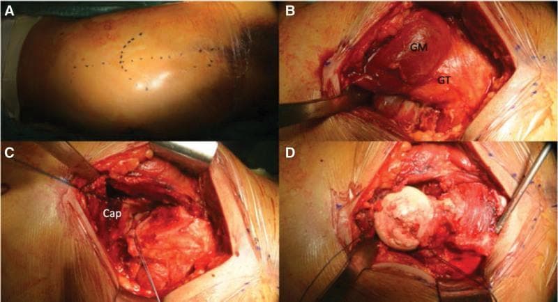 A series of four clinical photographs (A–D) documenting a surgical hip dislocation procedure following Ganz's technique for cartilage repair. (A) Preoperative skin marking on the lateral right thigh shows a longitudinal incision line approximately 10 cm in length, centered over the greater trochanter (GT). (B) Intraoperative view showing surgical exposure of the gluteus medius (GM) and the posterior aspect of the greater trochanter (GT) prior to trochanteric osteotomy. (C) Deep surgical dissection illustrating the disrupted hip joint capsule (Cap) following anterior and superior capsulotomy. (D) View of the dislocated femoral head, which exhibits a large, irregular chondral defect on the superior-lateral weight-bearing surface, measuring approximately 35 mm × 27 mm. The surrounding healthy cartilage and the exposed subchondral bone are visible within the operative field. This surgical approach provides full 360-degree access to the femoral head while preserving its vascularity for subsequent procedures such as mosaicplasty.