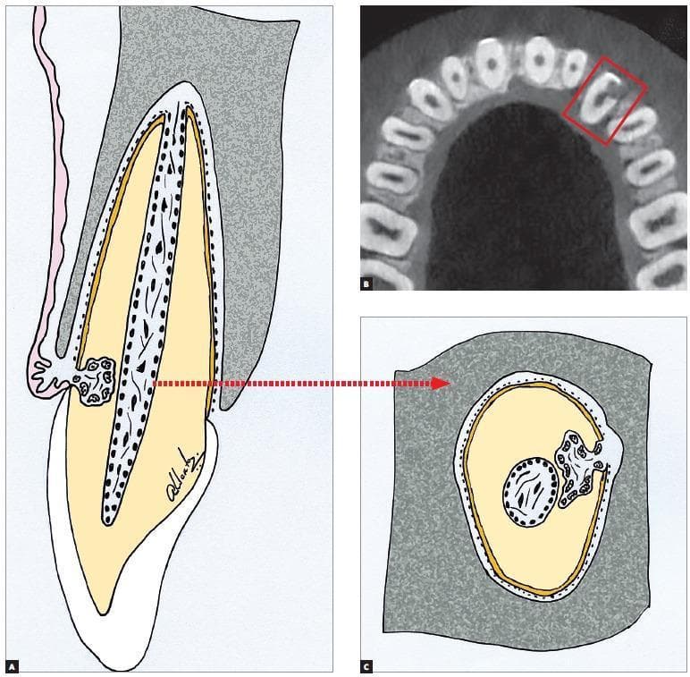 This composite educational resource illustrates external cervical resorption (ECR) through schematic diagrams and diagnostic imaging. Panel A shows a sagittal-view anatomical diagram of a tooth, highlighting a resorptive lesion originating at the cervical region and penetrating the dentine. Panel C provides a corresponding transverse-view diagram, emphasizing that the resorption circumvents the dental pulp without invading the pulp chamber, due to the protective layer of non-mineralized predentine. Panel B displays a Cone Beam Computed Tomography (CBCT) axial slice of the maxillary arch, with a red box identifying a radiolucent lesion on the cervical aspect of a tooth, correlating with the schematics. The visual demonstrates the key diagnostic feature of ECR: the preservation of the pulpal limits and a thin layer of mineralized dentine separating the lesion from the pulp space. This distinction is critical for differential diagnosis from internal resorption and informs treatment planning aimed at preserving pulp vitality. The material is intended for endodontic and orthodontic education, focusing on pathophysiology and radiographic interpretation.