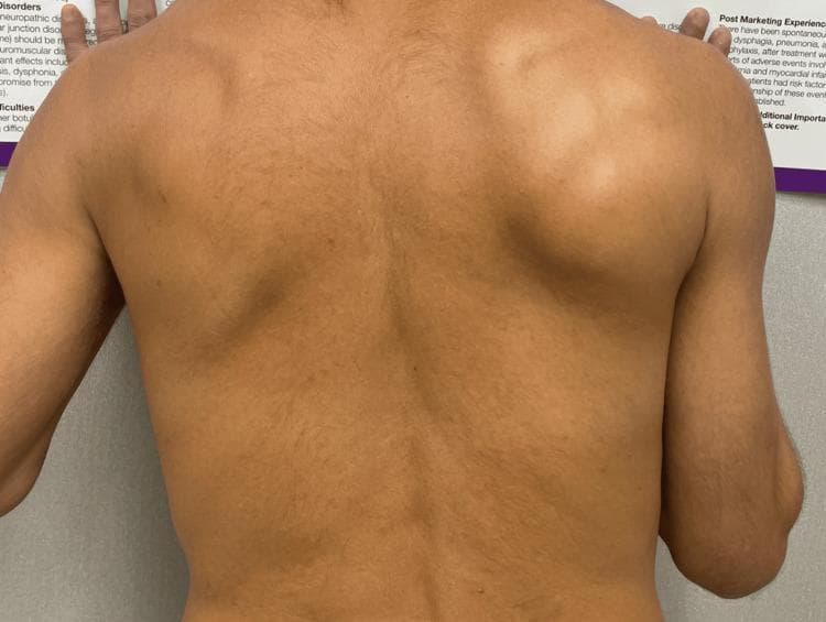 This clinical photograph shows a posterior view of a patient's upper back and shoulders during a wall-push physical examination maneuver. The image demonstrates a clear case of right-sided scapular winging. Specifically, the right scapula is displaced laterally and posteriorly, with its medial border and inferior angle protruding prominently from the thoracic cage. This creates a visible asymmetric contour when compared to the neutral, stabilized left scapula. The right shoulder also appears slightly depressed. This clinical finding is often associated with neurological or muscular dysfunction, such as long thoracic nerve palsy affecting the serratus anterior muscle or injury to the spinal accessory nerve affecting the trapezius. The visual evidence of winging during forward flexion or a wall-push highlights the instability of the scapulothoracic joint, which is a key diagnostic sign in patients presenting with shoulder pain, weakness, or limited range of motion related to brachial neuritis or other neuromuscular conditions.