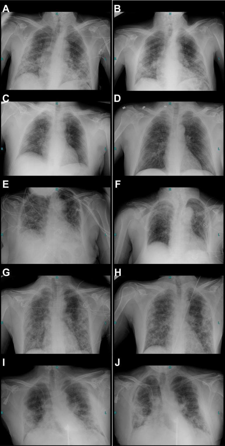 This composite educational graphic presents ten posterior-anterior (PA) or anteroposterior (AP) chest X-ray panels (A-J), organized as longitudinal comparison pairs demonstrating the progression or regression of COVID-19 pneumonia across five different patients. The images illustrate a spectrum of diagnostic findings including bilateral patchy reticular opacifications, ground-glass opacities, and perihilar and peripheral consolidations with lower zone predominance. Key pathological features visible across various stages include subsegmental atelectasis, reticulonodular patterns, and pleural effusions. For instance, panels (A) and (B) show minor regression of patchy opacifications following treatment, while panels (I) and (J) demonstrate disease progression, specifically highlighted by increased bilateral consolidation, the development of a right-sided pleural effusion, and a small right apical pneumothorax. The series serves as a clinical reference for monitoring viral pneumonia, secondary bacterial co-infections (e.g., Staphylococcus aureus, Klebsiella pneumoniae), and the radiological impact of advanced therapies like blood purification and cytokine control in critical care settings.