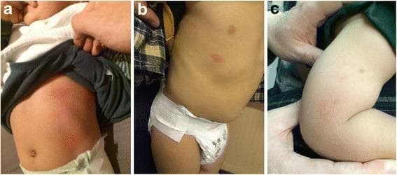 This composite of three clinical photographs documents a case of amoxicillin-induced immediate hypersensitivity in a pediatric patient. Figure 3a shows a pediatric abdomen with widespread, confluent, erythematous urticarial plaques (hives) that developed on day 3 of treatment. The rash exhibits characteristic raised, edematous morphology with poorly defined borders due to coalescence. Figure 3b displays the torso 15 minutes after an oral provocation challenge with a low dose of amoxicillin, demonstrating discrete, localized, circular erythematous wheals. Figure 3c illustrates a positive intradermal skin test on the forearm, showing a diagnostic wheal-and-flare reaction (measured at 8x16 mm) indicating IgE-mediated sensitization. The images collectively demonstrate the clinical manifestations of drug-induced urticaria and the subsequent diagnostic evaluation using oral challenge and skin prick testing in an allergy and immunology context. Educational focus includes recognizing the difference between confluent drug eruptions and discrete wheals, as well as the visual presentation of a positive skin test result.