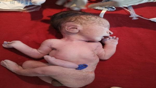 Clinical photograph of a newborn infant in a supine position, demonstrating several craniofacial dysmorphic features and congenital anomalies. Key findings include right-sided anophthalmia (complete absence of the eyeball and orbital cavity), a prominent beaked nose, severe micrognathia (undersized jaw), and posteriorly rotated, low-set ears. The infant exhibits generalized skin mottling (cutis marmorata appearance) and a blue umbilical cord clamp is visible on the abdomen. The overall posture shows moderate flexion of the extremities. This image is used in neonatological and genetic contexts to illustrate syndromic presentations or midline defects. The photograph serves as a medical reference for identifying distinct morphological patterns associated with rare congenital disorders during initial newborn physical examination.