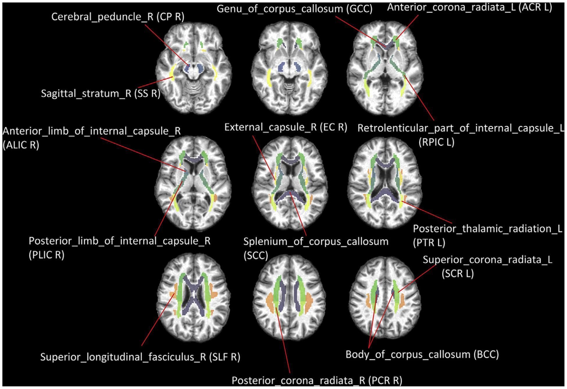 This diagnostic image provides a series of nine axial brain slices at various levels, serving as an anatomical diagram of major white matter (WM) tracts based on the JHU-MNI-ss atlas. The illustration utilizes color-coded segmentation to highlight key neuroanatomical structures within the deep white matter. Labeled structures include the commissural fibers of the corpus callosum (Genu - GCC, Body - BCC, and Splenium - SCC) and the projection fibers of the internal capsule (Anterior Limb - ALIC, Posterior Limb - PLIC, and Retrolenticular Part - RPIC). Additionally, the diagram identifies components of the corona radiata (Anterior - ACR, Superior - SCR, and Posterior - PCR) and association fibers such as the Superior Longitudinal Fasciculus (SLF) and External Capsule (EC). Other visible regions include the Cerebral Peduncle (CP), Sagittal Stratum (SS), and Posterior Thalamic Radiation (PTR). This visualization is designed for educational use in neurology and radiology to demonstrate the spatial distribution and trajectory of functional pathways connecting the cerebral cortex, subcortical nuclei, and brainstem.