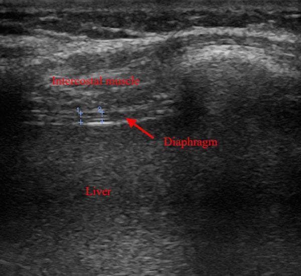 This diagnostic ultrasound image demonstrates the anatomical assessment of the diaphragm using a high-frequency linear probe. The imaging captures the zone of apposition, where the diaphragm is visible as a thin, relatively hypoechoic muscular layer sandwiched between two echogenic lines (the pleural and peritoneal membranes). Superficially, the intercostal muscle exhibits a heterogeneous echotexture, while deep to the diaphragm, the liver parenchyma presents with a more homogeneous, mid-level echogenicity. A red arrow identifies the diaphragm, and two vertical blue electronic calipers (labeled 1 and 2) demonstrate the clinical technique for measuring diaphragm thickness. This imaging modality is used in critical care settings to monitor for diaphragmatic atrophy or dysfunction in patients undergoing mechanical ventilation. Key landmarks included are the intercostal muscles, diaphragm, and liver, highlighting the use of point-of-care ultrasound (POCUS) for respiratory muscle monitoring.