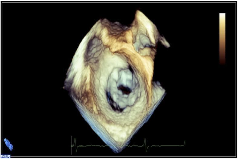 This diagnostic image is a 3D echocardiogram reconstruction of the heart, specifically providing an 'en face' view of the mitral valve. The image illustrates severe mitral valve stenosis, likely secondary to rheumatic heart disease. Key visual features include significant thickening and calcification of the valve leaflets, which appear rigid and echo-dense. There is evidence of commissural fusion, resulting in a markedly reduced and restricted mitral valve orifice (the 'fish-mouth' appearance). The surrounding valvular anatomy shows distorted morphology and increased tissue density, indicative of chronic fibrotic changes. This visual is characteristic of advanced valvular disease requiring clinical intervention such as mitral commissurotomy. The echocardiogram also includes a simultaneous EKG tracing at the bottom of the frame for temporal correlation within the cardiac cycle.