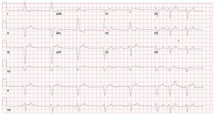 This diagnostic image is a 12-lead electrocardiogram (ECG) printed on standard grid paper, demonstrating key findings associated with severe hyperkalemia in a clinical setting. The rhythm is irregularly irregular with a notable absence of discrete P waves, replaced by fibrillatory activity, characteristic of atrial fibrillation. There is a slow ventricular response (bradycardia). The QRS complexes are significantly widened (exceeding 120 ms), showing a diffuse intraventricular conduction delay. In the limb leads, a left axis deviation is present. Notably, the T waves in multiple leads, particularly the precordial leads V2-V6, appear peaked or 'tented,' which is a classic electrophysiological sign of electrolyte imbalance, specifically hyperkalemia. The combination of bradyarrhythmia, widened QRS, and peaked T waves suggests a high risk for progression to sine wave pattern or ventricular asystole. This ECG serves as a critical educational example of the metabolic effects on cardiac conduction and is relevant for emergency medicine, nephrology, and cardiology specialties.