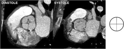 This diagnostic image displays axial cardiac computed tomography (CT) scans illustrating a rare congenital heart anomaly: a quadricuspid aortic valve (QAV). The content is presented in two side-by-side frames depicting different phases of the cardiac cycle. The left frame, labeled 'DIASTOLE', shows the aortic valve in its closed state, characterized by four distinct leaflets meeting at a central point to form a 'cross' or 'X' shape closure line. The right frame, labeled 'SYSTOLE', demonstrates the valve in its open configuration, revealing a central orifice for blood ejection. Anatomical landmarks are labeled for spatial orientation: the Right Ventricular Outflow Tract (RVOT) is positioned inferiorly and the Left Atrium (LA) is situated laterally to the central aortic valve. A schematic diagram to the far right further clarifies the four-quadrant geometric arrangement of the leaflets. This comparison is clinically significant for diagnosing valvular morphology and assessing potential functional impairments like aortic regurgitation or stenosis associated with non-tricuspid variants.