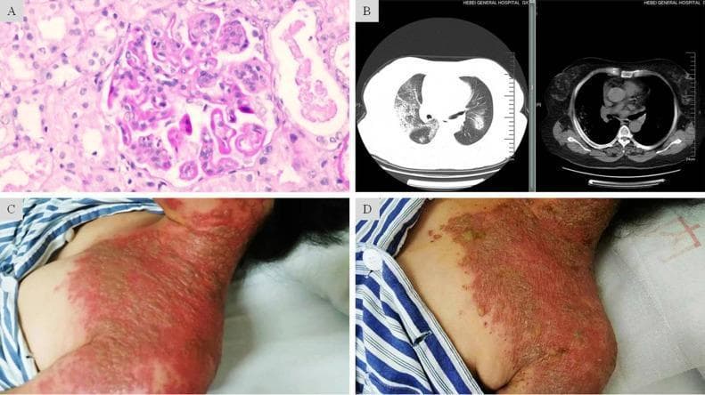 A composite medical image featuring four panels (A-D) illustrating clinical, radiological, and pathological findings of a complex case involving Lupus Nephritis and severe Herpes Zoster. Panel A is a light microscopy image (H&E stain) of a renal biopsy showing glomerular endothelial and mesangial hypercellularity with characteristic 'wire-loop' lesions, consistent with Class IV-G Lupus Nephritis. Panel B presents axial chest CT scans (lung and mediastinal windows) displaying bilateral, scattered patchy and nodular opacities with ill-defined borders, suggestive of diffuse alveolar hemorrhage. Panels C and D are clinical photographs of the neck and chest region showing the progression of skin lesions. Panel C depicts the acute phase of Herpes Zoster, characterized by confluent, grouped vesicles on an intense erythematous base extending across multiple dermatomes. Panel D shows the same region post-antiviral treatment, demonstrating resolving lesions with dried-up exudate and crusting on a fading erythematous base. This figure serves as an educational resource for multi-organ manifestations in immunocompromised patients, specifically highlighting systemic lupus erythematosus complications and disseminated viral infection.