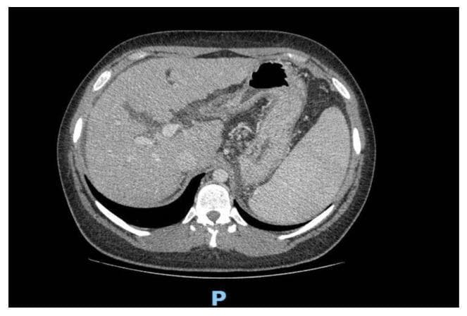 Axial non-contrast abdominal computed tomography (CT) scan illustrating advanced hepatic pathology. The liver demonstrates an inhomogeneous parenchymal appearance with multiple hyperdense regenerative cirrhotic nodules. Anatomical changes include an enlarged caudate lobe and blunt hepatic margins, characteristic of chronic liver disease. Associated secondary findings of portal hypertension are visible, specifically significant splenomegaly and an ectatic portal vein measuring approximately 17 mm. The stomach is visible with a pocket of intraluminal air (hypodense), and the posterior aspect shows the vertebral column and paraspinal musculature. This diagnostic image serves as a clinical example of cirrhosis-related morphological changes and secondary vascular complications within the hepatobiliary system.