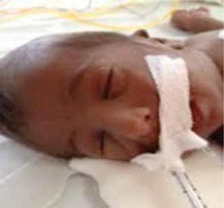 Clinical photograph of a neonate in a supine position, demonstrating dysmorphic facial features and generalized cutaneous findings. The infant exhibits widespread, dark hyperpigmentation across the entire face and scalp. Significant dysmorphic features include a flattened nasal bridge, small and low-set ears, and retrognathia (receding lower jaw). The infant is shown in a clinical setting with medical adhesive and tubing visible near the mouth, indicative of neonatal intensive care. These visual signs, particularly the generalized hyperpigmentation in a newborn, are highly suggestive of primary adrenal insufficiency or congenital adrenal hypoplasia/agenesis, where elevated ACTH levels lead to increased melanin production. This image serves as an educational example of the clinical presentation of neonatal endocrine disorders and associated craniofacial anomalies.