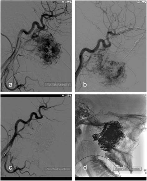This composite of four lateral-view diagnostic images documents the preoperative embolization of a juvenile nasopharyngeal angiofibroma (JNA) via direct puncture. Image (a) is a pre-interventional digital subtraction angiography (DSA) showing a hypervascular tumor mass with dense pathological blush and disorganized vessel architecture. Image (b) captures the procedural stage, demonstrating the needle position during direct percutaneous puncture of the lesion for the administration of embolic agents. Image (c) presents the post-interventional control DSA, illustrating a marked devascularization of the tumor bed and the near-total disappearance of the previously visible vascular blush, confirming successful occlusion of the feeding vessels. Image (d) is a post-interventional radiograph without digital subtraction, showing the accumulation of radio-opaque embolic material within the tumor margins against the anatomical background of the skull base and facial bones. The series serves as an educational example of interventional neuroradiology techniques used to reduce intraoperative hemorrhage during subsequent surgical resection of benign but highly vascular head and neck tumors.