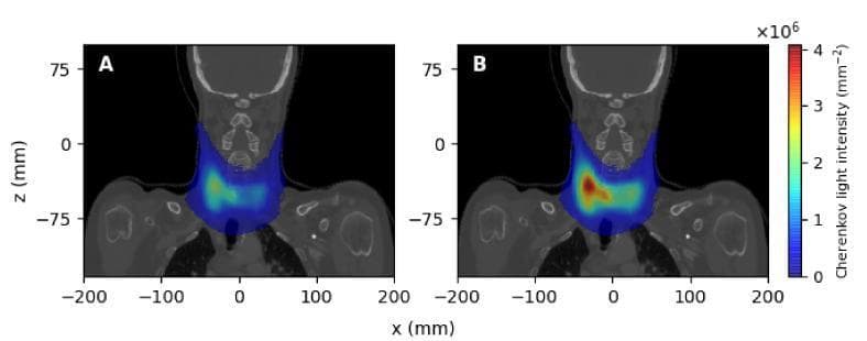 This diagnostic image set displays spectrally-integrated Cherenkov light intensity overlaid on coronal CT slices of a patient's neck, illustrating surface emission during hyperthyroidism treatment. Panels A and B represent administered Iodine-131 (I-131) activities of 400 MBq and 700 MBq, respectively. The heatmaps demonstrate the spatial distribution of light intensity emerging from the thyroid region, with a color scale ranging from blue (low intensity) to red/yellow (high intensity, up to 4x10^6 mm^-2). In Panel A, the emission is diffuse and centered over the thyroid lobes with lower peak intensity values. In Panel B, corresponding to higher radioactive activity, there is a more localized and prominent 'hot spot' of higher intensity on one side of the neck. This visualization serves as an educational tool for molecular radiotherapy (MRT) dosimetry, demonstrating how Cherenkov emission can correlate with internal radionuclide distribution and activity levels within anatomical structures like the thyroid gland.