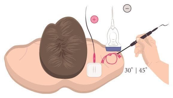 Educational illustration demonstrating the setup for Ultrasound (US)-guided percutaneous electrolysis for the treatment of shoulder tendinopathy, specifically targeting the supraspinatus tendon. The diagram depicts a patient in a supine position with the right shoulder area exposed. A linear ultrasound transducer is placed on the anterior shoulder for real-time visualization of the tendon. An acupuncture needle, functioning as the cathode (-), is inserted at a 30° to 45° angle to the skin surface, following a long-axis approach toward the target tissue under the probe. A surface electrode pad is placed over the upper trapezius muscle to serve as the anode (+), completing the galvanic current circuit. The illustration highlights the spatial relationship between the transducer, the needle insertion angle, and the electrical circuit configuration necessary for delivering therapeutic microtrauma to the affected tendon structure.