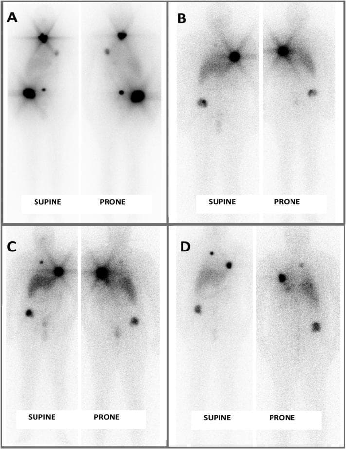 This diagnostic image series presents four sets of serial radioactive iodine (I-131) whole-body scintigraphy scans (labeled A through D) taken at 6-month intervals. Each set includes supine and prone projections. The scans track the treatment response of metastatic follicular thyroid carcinoma (FTC). Scan A shows high-intensity focal uptake in the thyroid bed/neck region and several metastatic lesions in the pelvis and upper chest. In subsequent scans (B, C, and D), there is a progressive reduction in both the number and the radiotracer intensity of these lesions, particularly in the neck and pelvic regions. This visual progression demonstrates a positive therapeutic response to repeated doses of radioactive iodine (RAI) therapy, indicating stable disease without new lesion development or metabolic progression. The images utilize nuclear medicine imaging to monitor systemic disease burden and the efficacy of targeted isotope therapy in a patient with metastatic thyroid malignancy.