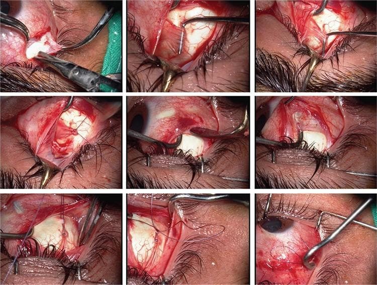 A series of nine intraoperative clinical photographs illustrating a modified Harada-Ito procedure with an adjustable suture technique for the treatment of superior oblique muscle palsy. The images depict a surgical field of the human eye, showing the temporal and superior aspects of the sclera following conjunctival peritomy. Key anatomical structures visible include the sclera, conjunctiva, eyelashes, and the superior oblique tendon. The sequence demonstrates the identification and isolation of the anterior fibers of the superior oblique tendon using muscle hooks. Surgical instrumentation, including forceps, Westcott scissors, and various retractors, are used to manipulate the extraocular tissue. Non-absorbable sutures are shown being placed through the anterior portion of the superior oblique tendon and anchored more anteriorly and laterally on the sclera to achieve torsion correction. The final frames highlight the adjustable suture loop, allowing for postoperative alignment modification. This surgical montage is an educational resource for ophthalmic surgeons and residents, demonstrating the technical steps for correcting excyclotorsion through the selective advancement of the superior oblique tendon fibers.