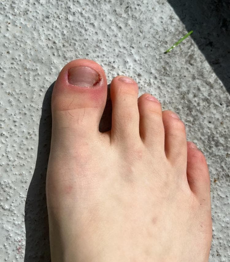 Clinical photograph of a right foot demonstrating skin and nail abnormalities associated with onychotillomania and chronic excoriation. The primary focus is the first toe (hallux), which displays significant nail plate shortening and distal-lateral onycholysis. The lateral nail fold exhibits acute-on-chronic paronychia, characterized by focal erythema, edema, and crusting, indicative of localized inflammation and secondary infection from repetitive trauma. While the medial portion of the nail shows signs of recent regrowth and less severe plate damage, the overall nail morphology remains irregular. The adjacent toes (second through fifth) appear largely uninvolved with normal skin tone and intact nail units. This image serves as a clinical example of self-induced dermatological injury (factitious disorder) and its infectious complications like paronychia, relevant for dermatology and psychiatry education regarding impulse control disorders and body-focused repetitive behaviors.