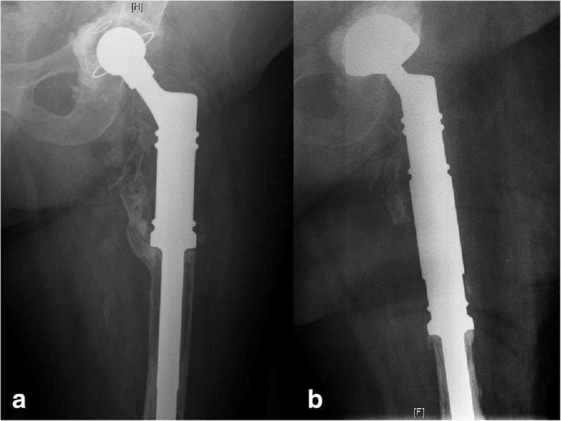 This comparison chart features two anteroposterior (AP) radiographs of the hip demonstrating a revision arthroplasty due to aseptic loosening. Image (a) depicts the preoperative state of a total hip arthroplasty. The visual findings show a modular acetabular cup and a long, smooth femoral stem. Key indicators of instability or aseptic loosening are present, including radiolucent zones at the bone-implant interface, suggesting a failure of biological or cement fixation. Image (b) shows the postoperative result following a revision surgery. This image illustrates the replacement of both components: a new, larger acetabular cup has been implanted, and the femoral stem has been exchanged for a modular revision system with a distinct geometry designed for enhanced stability in the femoral canal. The radiograph confirms improved alignment and mechanical fixation. This visual is used for medical education to teach orthopaedic residents about radiographic signs of implant failure and the surgical management of complex hip revision using modular arthroplasty systems.