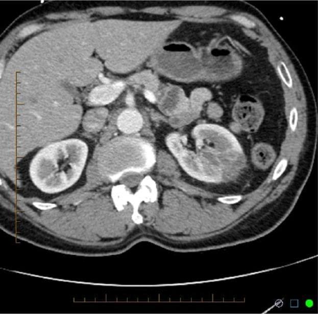 This diagnostic image is an axial contrast-enhanced CT scan of the abdomen at the level of the renal hilum. The primary finding is a well-circumscribed, wedge-shaped area of hypoenhancement in the mid-to-posterior (interpolar) region of the left kidney, characteristic of an acute renal infarction. This non-enhancing defect contrasts sharply with the normally enhancing renal parenchyma of the remaining left kidney and the entirely normal, uniformly enhancing right kidney. Other visible anatomical structures include the liver, which appears homogeneous; the gallbladder; the abdominal aorta and inferior vena cava; and sections of the stomach and bowel. No evidence of significant hydronephrosis or perirenal fat stranding is observed on this slice. The image serves as a classic educational example of the radiological presentation of renal segmental ischemia, highlighting the classic wedge-shaped pattern following the distribution of a segmental renal artery.
