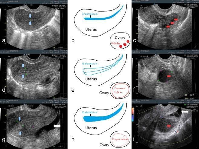 This composite figure illustrates transvaginal ultrasonography (TVUS) findings of the uterus and ovaries throughout the menstrual cycle, organized into three phases: early follicular (a-c), late follicular (d-f), and post-ovulatory luteal (g-i). In the early follicular phase, the endometrium is thin and homogenous (blue arrows), with multiple small antral follicles (red arrows) visible in the ovary. The late follicular phase displays a thickened endometrium with a characteristic 'triple-line' pattern (d) and a large, hypoechoic dominant follicle approximately 2 cm in diameter (f). The luteal phase shows a 'luteinized' endometrium with increased echogenicity (g) and the transformation of the dominant follicle into a corpus luteum (i), characterized by an inhomogenous internal structure and filament-like contents. Anechoic free fluid in the pelvis, indicative of recent ovulation, is highlighted by white arrows in the late follicular and luteal phase images. Schematic diagrams (b, e, h) provide anatomical context for the sonographic changes in endometrial morphology and ovarian follicle development.