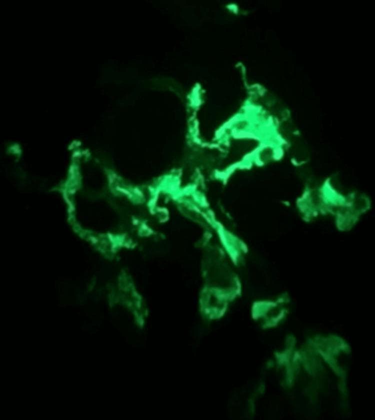 This diagnostic image shows immunofluorescence microscopy of a renal biopsy specimen, specifically demonstrating glomerular IgA staining. Set against a dark background, the image reveals intense apple-green fluorescence within the mesangium and along some capillary loops of a glomerulus. The staining pattern is granular and predominantly mesangial, characterized by irregular clumps and lobulated deposits of IgA immune complexes. This visual finding is a hallmark diagnostic feature of IgA nephropathy (Berger disease) or IgA vasculitis (Henoch-Schönlein purpura) in a clinical context of palpable purpura and subnephrotic proteinuria. The distribution illustrates the localization of immunoglobulin A deposits within the glomerular tuft, which is essential for differentiating immune-mediated glomerulonephritides.