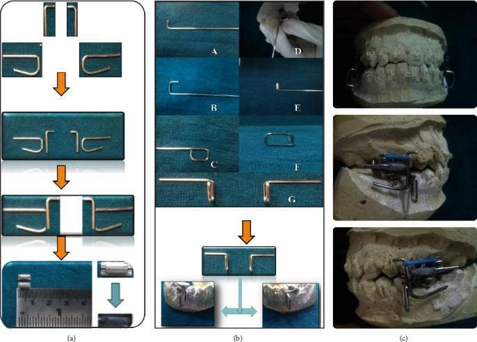 This orthodontic technical diagram and clinical photograph series illustrate the fabrication steps for an in-house Mandibular Anterior Repositioning Appliance (MARA). Panel (a) shows the sequential assembly of the upper component, utilizing 0.036-inch stainless steel wires bent into L-shaped and U-shaped configurations, which are spot-welded and soldered to create a 'Swan' shaped distal incline. Panel (b) details the fabrication of the lower assembly, featuring a rectangular wire frame (4 mm x 5 mm) with a retentive arm bent 90 degrees to fit the buccal surface of lower molar bands. Panel (c) displays the completed appliance mounted on dental plaster casts, demonstrating the integrated functional mechanism. The clinical purpose of this rigid fixed functional appliance is to correct skeletal Class II malocclusions by guiding the mandible into a forward, edge-to-edge incisal relationship through growth modification and dentoalveolar changes. The images highlight the customized soldering and adaptation of components to orthodontic bands for therapeutic intervention in pediatric or adolescent patients.