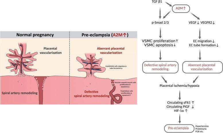 A multi-part medical illustration and signaling pathway diagram detailing the role of Alpha-2-Macroglobulin (A2M) in the pathophysiology of pre-eclampsia (PE). The left panel features a comparative anatomical diagram showing 'Normal pregnancy' versus 'Pre-eclampsia (A2M ↑)'. Normal pregnancy displays healthy placental vascularization with extensive branching and effective spiral artery remodeling (wide, dilated vessels). In contrast, pre-eclampsia exhibits 'aberrant placental vascularization' with sparse branching and 'defective spiral artery remodeling' characterized by narrow, un-remodeled vessels. The right panel outlines a signaling algorithm: TGF ̢1 and increased A2M stimulate p-Smad 2/3, leading to increased vascular smooth muscle cell (VSMC) proliferation and decreased apoptosis, causing defective remodeling. Simultaneously, increased A2M inhibits VEGF/VEGFR2, reducing endothelial cell (EC) migration and tube formation, causing aberrant vascularization. These pathways converge at placental ischemia/hypoxia, which increases circulating sFlt1 and HIF-1̑ and decreases PlGF, culminating in clinical pre-eclampsia symptoms including hypertension, proteinuria, and fetal growth restriction (FGR).
