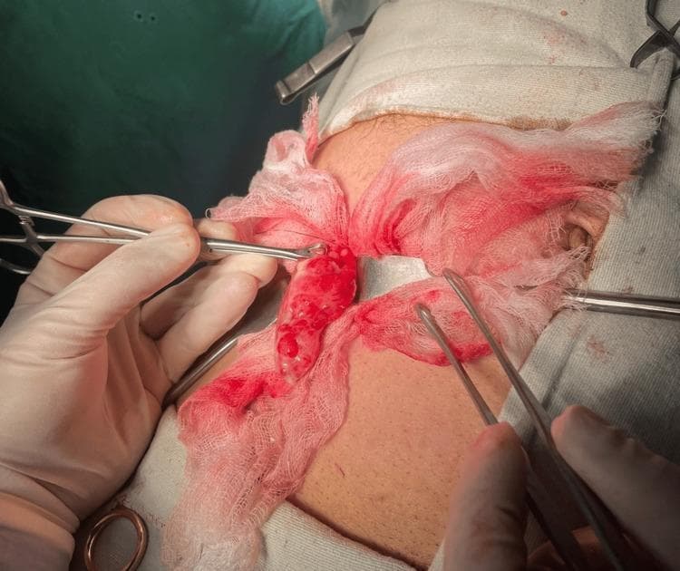 This clinical photograph captures an intraoperative view of an open appendectomy. An inflamed, erythematous, and enlarged appendix is being exteriorized through a gridiron incision at McBurney's point. The appendix exhibits signs of acute inflammation, including significant hypervascularity and a thickened, irregular surface texture. Surgical instruments, including a Babcock forcep and other clamps, are visible as they manipulate the tissue. The operative field is packed with blood-stained sterile gauze to maintain visibility and control minor bleeding from the surrounding subcutaneous tissue and skin. The surrounding area is draped with sterile surgical towels. This image serves as an educational example of the surgical presentation of acute appendicitis, secondary to an obstructing appendicolith, highlighting the gross pathological changes of the organ and the standard surgical environment for an open abdominal procedure.
