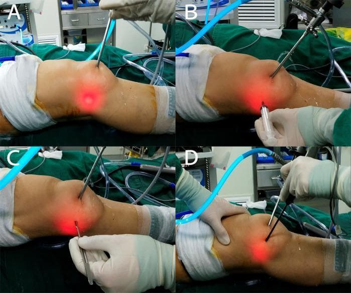 This set of four clinical photographs (A-D) demonstrates the intraoperative steps for establishing an auxiliary extreme lateral approach during knee arthroscopy. The patient's knee is prepped and draped in a standard sterile fashion. Image A shows the transillumination technique, where an arthroscope inside the joint creates a focal red light on the lateral aspect of the knee to guide portal placement. Image B illustrates the 'outside-in' technique using a spinal needle and syringe to confirm the entry point and trajectory into the joint space. Image C depicts the insertion of a switching stick or guide wire through the newly established portal, while an intra-articular instrument is positioned to receive it. Image D shows the final placement of an arthroscopic cannula or working instrument through the extreme lateral approach, with manual stabilization of the limb. This sequence highlights surgical techniques for improving access to lateral compartment structures, such as the lateral meniscus or popliteus tendon, during orthopedic procedures.