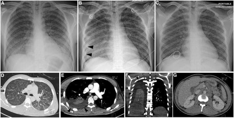 This composite figure displays a longitudinal imaging series of a 24-year-old male with miliary tuberculosis (TB). (A-C) Serial frontal chest radiographs show the progression and management of pleural complications. Initial radiograph (A) reveals bilateral, fine, micronodular interstitial opacities (miliary pattern). Follow-up (B) demonstrates the development of a right-sided pleural effusion, indicated by blunting of the costophrenic angle and peripheral opacification (arrowheads). Post-drainage film (C) shows resolution of the effusion with a pigtail catheter in situ. (D) Axial lung-window CT confirms diffuse, randomly distributed miliary nodules. (E-F) Axial and coronal mediastinal-window CTs demonstrate a moderate right pleural effusion (arrowheads) and associated compressive atelectasis in the right lower lobe. (G) Axial contrast-enhanced abdominal CT reveals extensive para-aortic and mesenteric lymphadenopathy, indicative of extrapulmonary TB involvement. The collection illustrates the classic radiographic and tomographic features of miliary TB, secondary pleural effusion, and associated abdominal lymphadenitis.