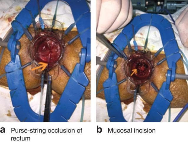 Two-panel clinical photograph illustrating the initial transanal steps of a Total Mesorectal Excision (TME) for rectal cancer. Both images demonstrate a surgical field with a blue Lone Star retractor positioned around the anus to provide circumferential exposure. Panel 'a' shows the purse-string suture technique (indicated by an orange arrow) used to occlude the distal rectal lumen. This ensures closure of the rectum below the tumor to maintain oncological safety and allow for insufflation. Panel 'b' demonstrates the subsequent mucosal incision (indicated by an orange arrow) performed below the purse-string line. An instrument is visible manipulating the tissue edge during the circumferential dissection of the rectal wall using electrocautery. The visible anatomy includes the perianal skin, anal canal, and the hyperemic rectal mucosa. This visual sequence is intended for surgical education, specifically for transanal minimally invasive surgery (TAMIS) or transanal TME (taTME) procedures.