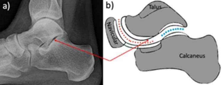 This composite educational graphic focuses on the anatomy of the subtalar joint, featuring (a) a lateral plain-film X-ray of a human foot and (b) a corresponding anatomical diagram. The X-ray demonstrates the talus positioned superiorly and the calcaneus inferiorly, with a red arrow pinpointing the subtalar (talocalcaneal) joint space. The adjacent schematic illustration further clarifies the complex articulation between the talus, calcaneus, and navicular bones. In the diagram, the talocalcaneal joint is delineated by blue dots, emphasizing the posterior facet articulation. The talocalcaneonavicular joint is marked by red dashed lines, showing the ball-and-socket relationship between the talar head, the anterior calcaneal facets, and the posterior surface of the navicular bone. This visual resource is designed for orthopedic and radiological education, specifically for understanding the functional anatomy of the hindfoot and midfoot joints involved in conditions like pes planus and procedures such as subtalar arthroereisis.