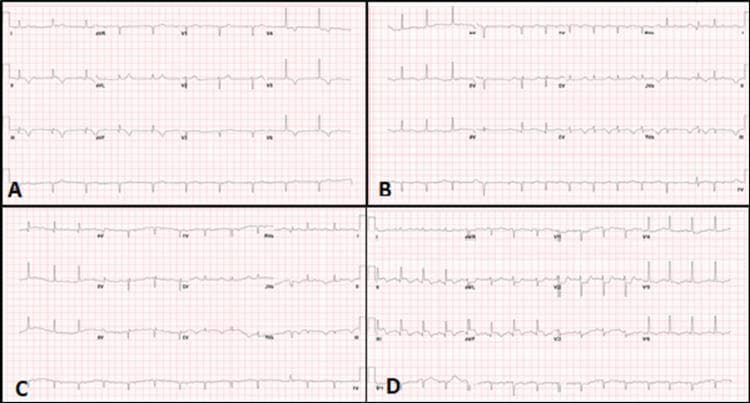 A comparative clinical diagnostic image featuring four 12-lead electrocardiogram (ECG) panels (A-D) demonstrating the evolution of atrioventricular (AV) conduction abnormalities and acute ischemia. Panel A shows third-degree (complete) AV block characterized by AV dissociation, where P waves and QRS complexes occur independently, accompanied by a narrow-complex junctional escape rhythm. Panel B illustrates second-degree AV block (Mobitz Type I/Wenckebach), showing progressive PR interval prolongation culminating in a non-conducted P wave. Panel C displays first-degree AV block with a consistently prolonged PR interval (>200ms) and sporadic premature ventricular complexes (PVCs). Panel D reveals an acute inferior-posterior ST-segment elevation myocardial infarction (STEMI), evidenced by significant ST-segment elevation in the inferior leads (II, III, aVF) with reciprocal changes in other leads. This sequence serves as a clinical education tool for identifying progressive cardiac conduction system disease and subsequent acute coronary events, highlighting the visual distinction between rhythm disturbances and acute ischemic manifestations.