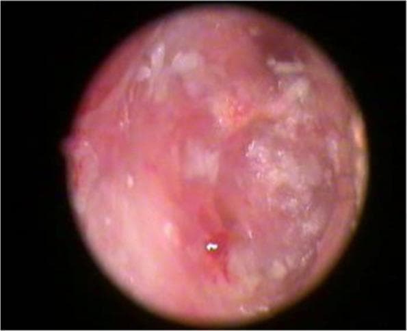 This clinical photograph, obtained via otoscopy or laryngoscopy, displays a postoperative view of a tympanic membrane graft (likely temporalis fascia) one month following myringoplasty. The image shows the graft positioned within the middle ear space, exhibiting a predominantly reddish-pink hue, which indicates early neovascularization and tissue integration. The membrane appears semi-translucent with an irregular, uneven surface texture and scattered whitish patches representing keratinization or residual surgical material. A small, persistent perforation or focal thinning is visible in the lower central quadrant. The surrounding ear canal walls appear healthy. This visual serves as an educational example of early-stage graft uptake and provides a clinical reference for assessing surgical success and potential residual defects in the immediate postoperative period for patients treated for chronic otitis media or tympanic membrane perforation.