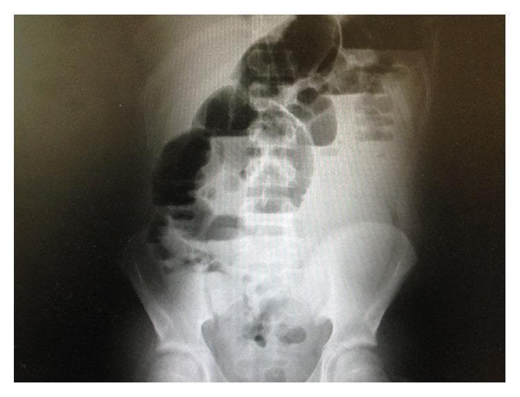 This abdominal radiograph (X-ray) shows a diagnostic image of the abdomen in a patient presenting with postoperative symptoms. The primary finding is the presence of several markedly dilated small bowel loops, primarily located in the upper and central abdominal regions. These loops exhibit significant gaseous distension and multiple air-fluid levels, characteristic of an intestinal obstruction or paralytic ileus. The degree of small bowel dilatation is disproportionate to the sparse amount of gas visible within the colon. Anatomical landmarks including the lumbar spine, sacrum, and pelvic bones (iliac crests and pubic symphysis) are clearly visible, providing spatial orientation. The radiographic presentation is highly suggestive of a mechanical small bowel obstruction, potentially related to postoperative adhesions or complications. This visual evidence serves as an educational tool for identifying typical radiological signs of bowel distension and air-fluid levels in acute surgical abdominal pathologies.