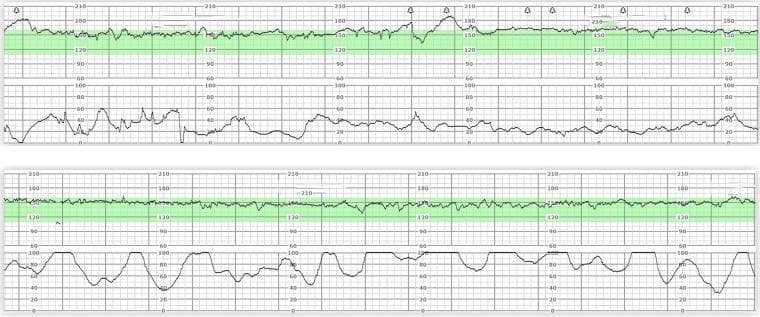 This diagnostic image displays two comparative sections of cardiotocography (CTG) strips, an essential tool in obstetrics for electronic fetal monitoring (EFM). Each strip is divided into two vertically aligned graphs. The upper graph tracks the fetal heart rate (FHR) in beats per minute (bpm), ranging from 30 to 210, with a green shaded area highlighting the normal baseline range (approximately 120–160 bpm). The lower graph monitors uterine activity (tocodynamometry), scaled from 0 to 100 relative units to indicate the frequency and duration of contractions. The top strip illustrates a baseline FHR with moderate variability and irregular, low-amplitude uterine activity. In contrast, the bottom strip demonstrates a progression to more frequent, regular, and higher-amplitude uterine contractions, indicative of active labor or uterine hyperstimulation. This visual serves to educate clinicians on interpreting fetal well-being in relation to labor progression and uterine contractions, which is critical for identifying potential fetal distress or evaluating the efficacy of tocolytic therapy.