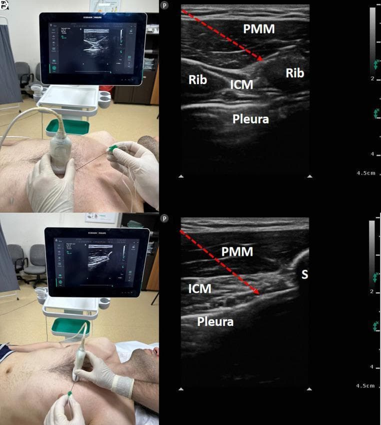 This composite clinical and diagnostic image demonstrates the technique and sonographic anatomy for parasternal intercostal plane (PIP) blocks. The left panels show clinical photographs of a linear ultrasound probe positioned on the anterior chest wall of a supine patient, aligned in parasagittal (top) and transverse (bottom) orientations near the sternal border, with a block needle being inserted in-plane. The right panels (labeled A-B and C-D in context) show corresponding high-frequency ultrasound views of the thoracic wall. Key anatomical layers identified include the pectoralis major muscle (PMM), intercostal muscles (ICM), and the hyperechoic pleural line. Ribs are visible as hyperechoic curved structures with posterior acoustic shadowing in the sagittal view, while the sternum (S) is seen in the transverse view. Red dashed arrows indicate the needle trajectory targeting the interfascial planes: the superficial PIP block (between PMM and ICM) and the deep PIP block (between ICM and the transversus thoracis/pleura). This material serves as a guide for regional anesthesia and pain management education.