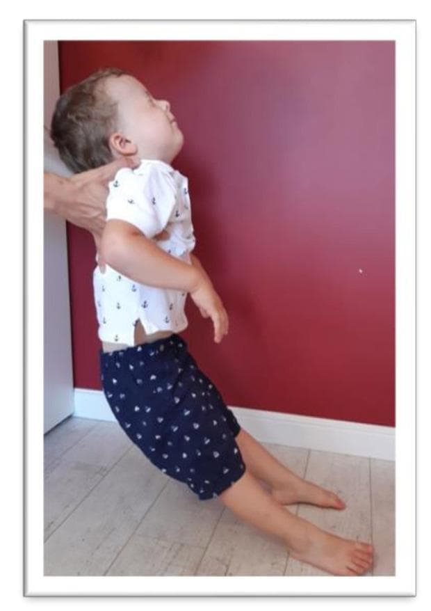 Clinical photograph illustrating the assessment of the Moro reflex in a preschool-aged child. The image depicts a therapist supporting the child's upper torso and head while the child is leaned backward. The child's head is in a position of cervical extension (tilted back) with eyes closed, which is a provocative maneuver to stimulate the vestibular system and trigger the reflex. The upper limbs are observed in a state of abduction or 'throwing out' to the sides, while the lower limbs show knee flexion. This clinical examination is used in pediatric neurology and physiotherapy to assess the integration of primitive reflexes. Persistent, unintegrated Moro reflexes beyond early infancy can indicate developmental delays or neurological maturity issues. The image demonstrates the standard physical therapy test position used to evaluate for residual reflex activity in older children, where compensatory movements like arm flailing or loss of balance are monitored.