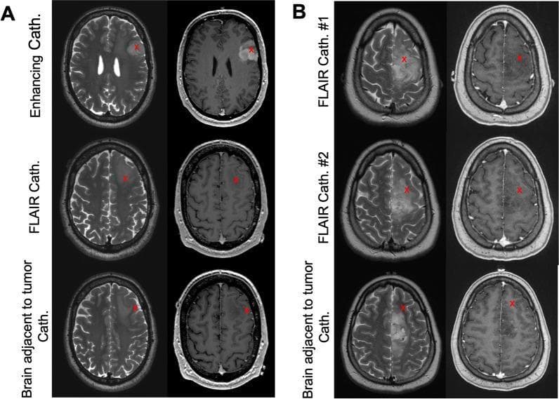 This diagnostic imaging set consists of axial brain MRI scans from two different patients (Panels A and B), displaying T2 Fluid-Attenuated Inversion Recovery (FLAIR) sequences on the left and T1-weighted post-contrast (gadolinium) sequences on the right. The images illustrate pre-operative surgical planning for stereotactic microdialysis catheter placement in gliomas. Red 'X' markers denote the targeted sampling locations. In Panel A (Enhancing Tumor), the scans demonstrate a lesion in the left hemisphere. The T2 FLAIR shows diffuse hyperintensity encompassing both the tumor core and surrounding vasogenic edema, while the T1-weighted post-contrast sequence reveals a specific focal area of vivid enhancement. Panel B (Non-Enhancing Tumor) shows a large right-sided lesion characterized by significant FLAIR hyperintensity but a lack of contrast enhancement on T1-weighted images. The targets categorized include 'Enhancing Cath' (contrast-positive tumor), 'FLAIR Cath' (hyperintense but non-enhancing tumor), and 'Brain adjacent to tumor Cath' (peritumoral tissue with normal signal intensity). These images serve to teach radiographic differentiation of glioma sub-regions based on blood-brain barrier integrity and fluid content.