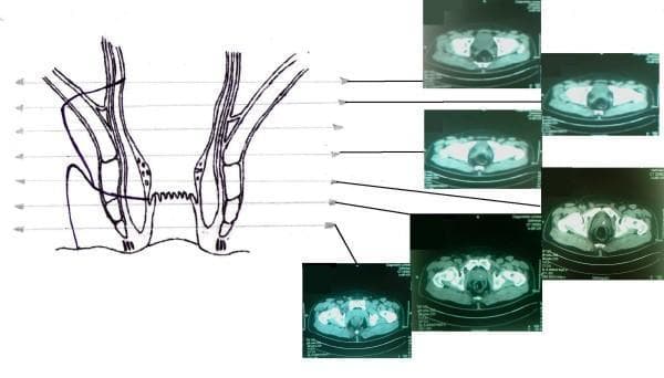 This composite educational image features a Comparison Chart and Diagnostic Image set correlating perianal anatomy with radiological findings. On the left, a coronal anatomical diagram of the rectum and anal canal illustrates two fistulous tracts originating from a shared internal orifice in the rectal wall. One tract demonstrates an extrasphincteric path, while the other shows the placement of a surgical seton. The diagram highlights key landmarks including the internal and external anal sphincters, the levator ani muscle, and the dentate line. Horizontal reference lines extend from different anatomical levels of the schematic to a series of six axial CT scans (labeled as MRI in context) on the right. These cross-sectional diagnostic images display the pelvic floor, rectal lumen, and surrounding soft tissues at sequential heights, facilitating a 3D understanding of the fistula's complex trajectory relative to the pelvic musculature. This material is designed for advanced medical education in colorectal surgery and radiology, focusing on the diagnosis and management of complex anal fistulas.