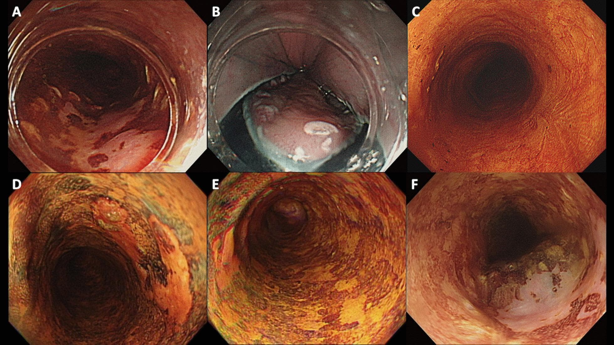This composite of six endoscopic images (A-F) illustrates the progression and surveillance of superficial esophageal squamous cell carcinoma (SESCC) post-endoscopic submucosal dissection (ESD), categorized by Lugol staining patterns. Images A and D show primary lesions: Type A background (A) displays a uniform pinkish-red hue, while Type D background (D) exhibits numerous irregular Lugol-void lesions (LVLs) with a variegated appearance. Image B shows the intraoperative ESD procedure. Image C demonstrates a successful post-procedural outcome with a smooth, homogeneous orange-red scar indicating no recurrence. In contrast, images E and F depict high-risk surveillance findings; image E shows a background with extensive LVLs (Type D), and image F demonstrates a metachronous recurrence, characterized by a textured, heterogeneous elevation and abnormal mucosal color compared to the primary scar tissue. This series highlights the clinical significance of Lugol chromoendoscopy in identifying high-risk mucosal backgrounds prone to metachronous esophageal cancer.