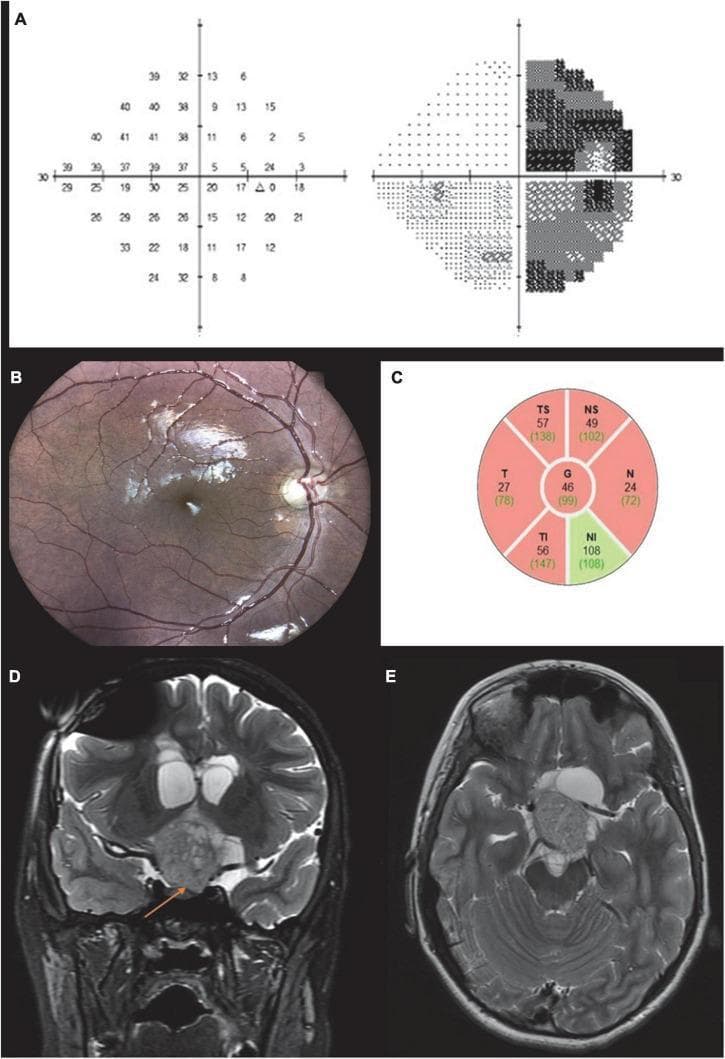 This composite medical image illustrates clinical and diagnostic findings of an optic tract lesion causing visual field and structural changes. Panel A displays a Humphrey automated perimetry result for the right eye, showing a temporal hemianopia (right hemianopia) with dense vision loss respecting the vertical meridian. Panel B is a fundus photograph of the right eye demonstrating 'bow-tie' atrophy of the optic disc, characterized by horizontal pallor involving the nasal and temporal sectors. Panel C provides an Optical Coherence Tomography (OCT) retinal nerve fiber layer (RNFL) map, showing significant thinning (indicated in red) in the temporal, nasal, and superior sectors, correlating with the visual field loss. Panels D and E show T2-weighted MRI scans in coronal and axial views, respectively, revealing a large heterogeneous mass at the optic chiasm and left optic tract, compressing the third ventricle. The collection demonstrates the characteristic clinical correlation between chiasmal/retrochiasmal lesions, specific patterns of optic nerve atrophy, and corresponding visual field defects.