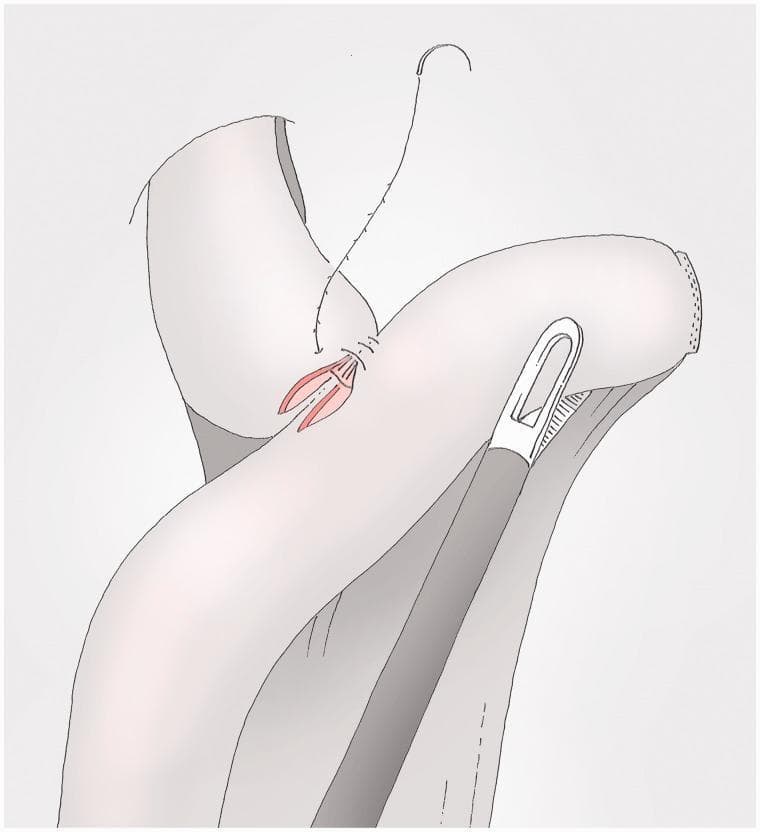 This medical illustration depicts a surgical technique for gastrointestinal anastomosis, likely part of a gastrectomy procedure. The diagram shows the suturing of a tissue layer using a barbed suture, characterized by small, unidirectional anchors along the thread, which allows for knotless wound closure. A curved surgical needle is attached to the superior end of the suture. The illustration highlights the relationship between the anterior and posterior suture layers, where the anterior layer overlaps the posterior one. A surgical instrument, possibly a laparoscopic grasper or stapler component, is positioned against the folded tissue. The reddish internal mucosal surface is visible through an incision, which is being approximated by the suture line. This visual serves as an educational resource for surgeons learning specialized suturing techniques in minimally invasive abdominal surgery, specifically focusing on secure, knotless anastomosis.
