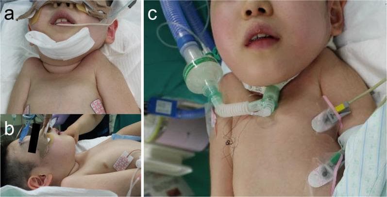 This three-panel clinical series documents a pediatric tracheostomy procedure. Panels 'a' and 'b' show the preoperative state with the patient in a supine position under general anesthesia. An oral endotracheal tube is secured with white tape and padding. Panel 'a' (anterior view) and panel 'b' (lateral view) demonstrate maximum neck extension to provide access to the anterior neck space, despite clinical evidence of limited mobility. ECG electrodes are visible on the upper chest. Panel 'c' shows the postoperative result following the insertion of a 5.5 Fr cuffed tracheostomy tube. The tracheostomy cannula is secured to the neck and connected via a clear adapter to a respiratory circuit including a heat and moisture exchanger (HME) filter and blue corrugated ventilator tubing. The image illustrates procedural management in a patient with difficult airway anatomy, specifically highlighting the transition from oral intubation to a permanent tracheostoma for long-term airway support and mechanical ventilation.