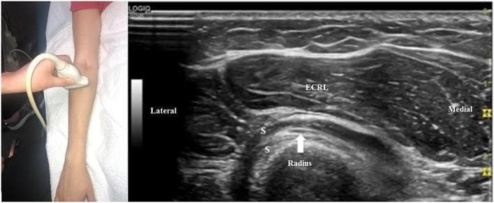 This composite image includes a clinical photograph showing ultrasound transducer placement on the proximal dorsal forearm and a corresponding cross-sectional diagnostic ultrasound image of the radial nerve anatomy. The ultrasound demonstrates the deep motor branch of the radial nerve, identified here as the posterior interosseous nerve (PIN), indicated by a white arrow. The PIN is visualized as a small, oval, hypoechoic structure with a fascicular pattern, coursing obliquely within the supinator muscle (labeled 'S'). The nerve is positioned between the superficial and deep heads of the supinator. Deep to the supinator is the radius, appearing as a prominent, convex, hyperechoic bony surface with posterior acoustic shadowing. Superficial to the supinator muscle is the extensor carpi radialis longus (ECRL), showing a characteristic pennate fibrillar echotexture. Lateral and medial orientations are labeled on the image. This imaging is clinically significant for evaluating nerve entrapment syndromes, such as radial tunnel syndrome or posterior interosseous nerve syndrome at the arcade of Frohse.